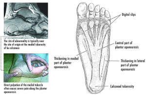 vancouver-plantar-fasciitis-therapy1