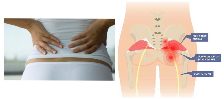 piriformis syndrome